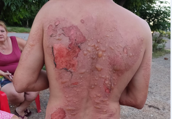 Rapaz desmaia no asfalto e tem queimaduras graves nas costas