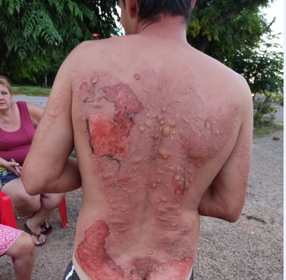 Rapaz desmaia no asfalto e tem queimaduras graves nas costas