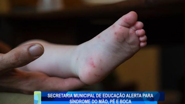 SECRETARIA MUNICIPAL DE EDUCAÇÃO ALERTA SOBRE SÍNDROME MÃO PÉ E BOCA